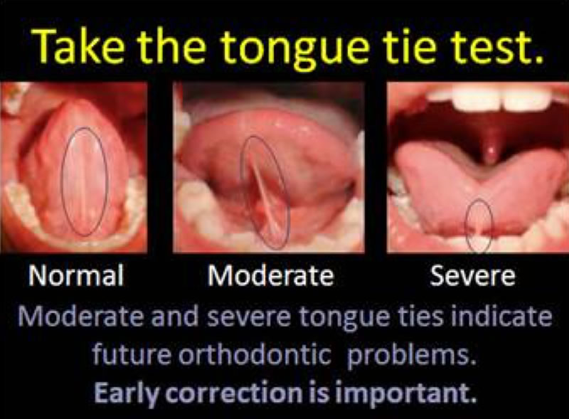 Tongue Tie Treatment Burlington Dentist Appleby Dental