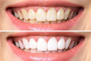 Teeth Whitening Burlington