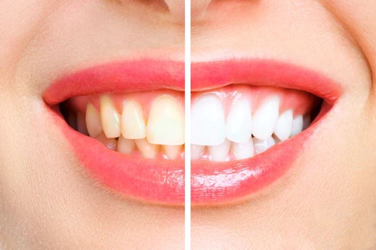 Top 5 Facts about Professional Teeth Whitening