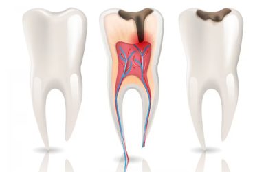Root Canal Therapy vs. Tooth Extraction