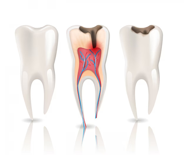 Root Canal Therapy vs. Tooth Extraction