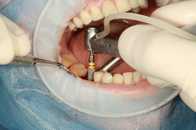 Things you need to know before getting Dental Implants