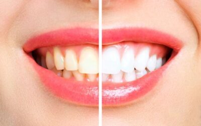 Top 5 Facts about Professional Teeth Whitening