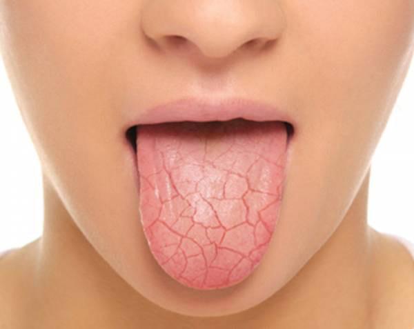 Understanding Dry Mouth: Facts and Tips