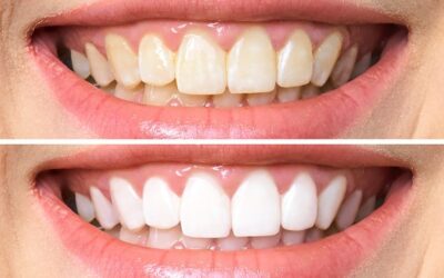 Teeth Whitening – Is It Worth It?