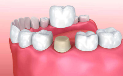 Is It Time for a Dental Bridge?