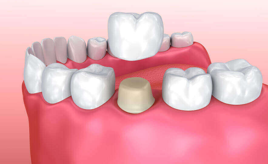 Is It Time for a Dental Bridge?
