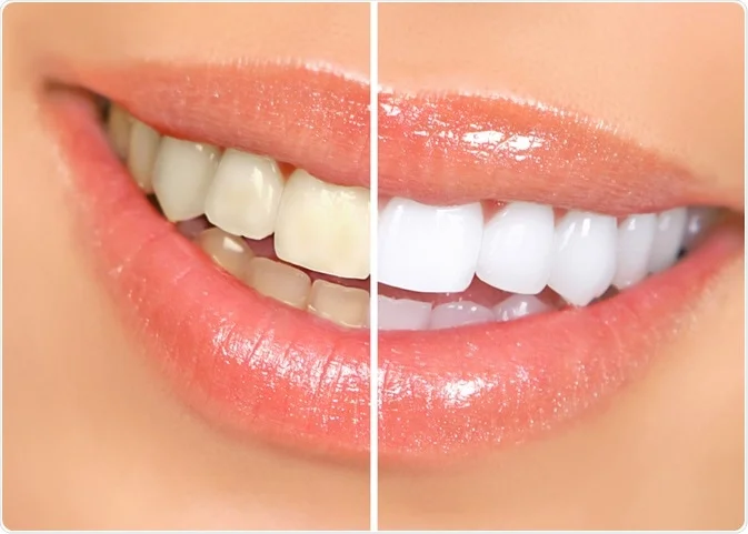 Teeth Whitening Burlington