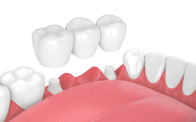 Dental Implants vs Dental Bridges: Which Option May Be Right for You?